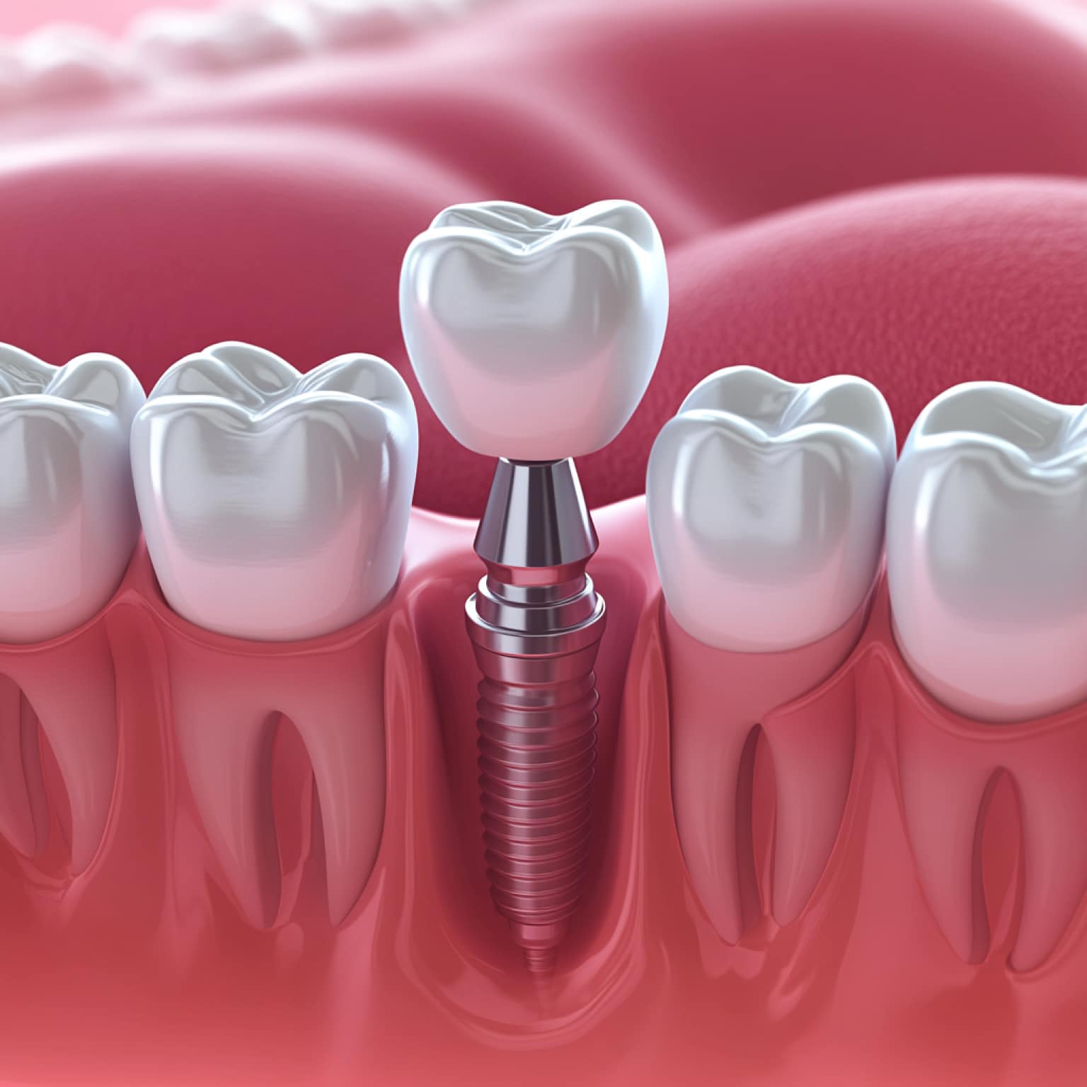 A dental illustration shows a tooth implant in the gum alongside natural teeth, highlighting the implant's metal screw structure and crown.